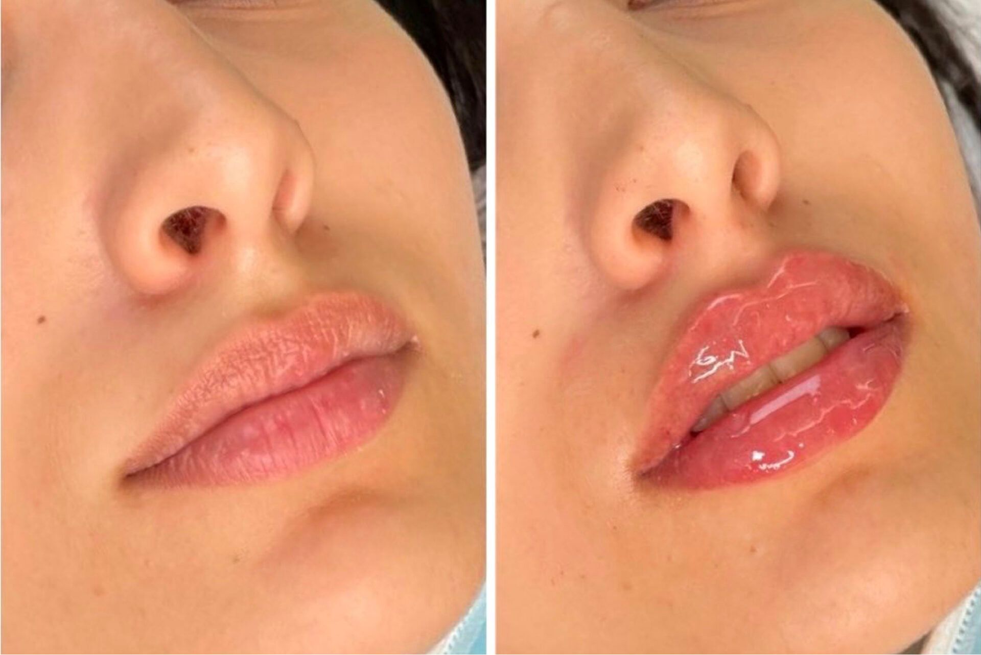 lipfiller den haag lip fillers den haag juvederm