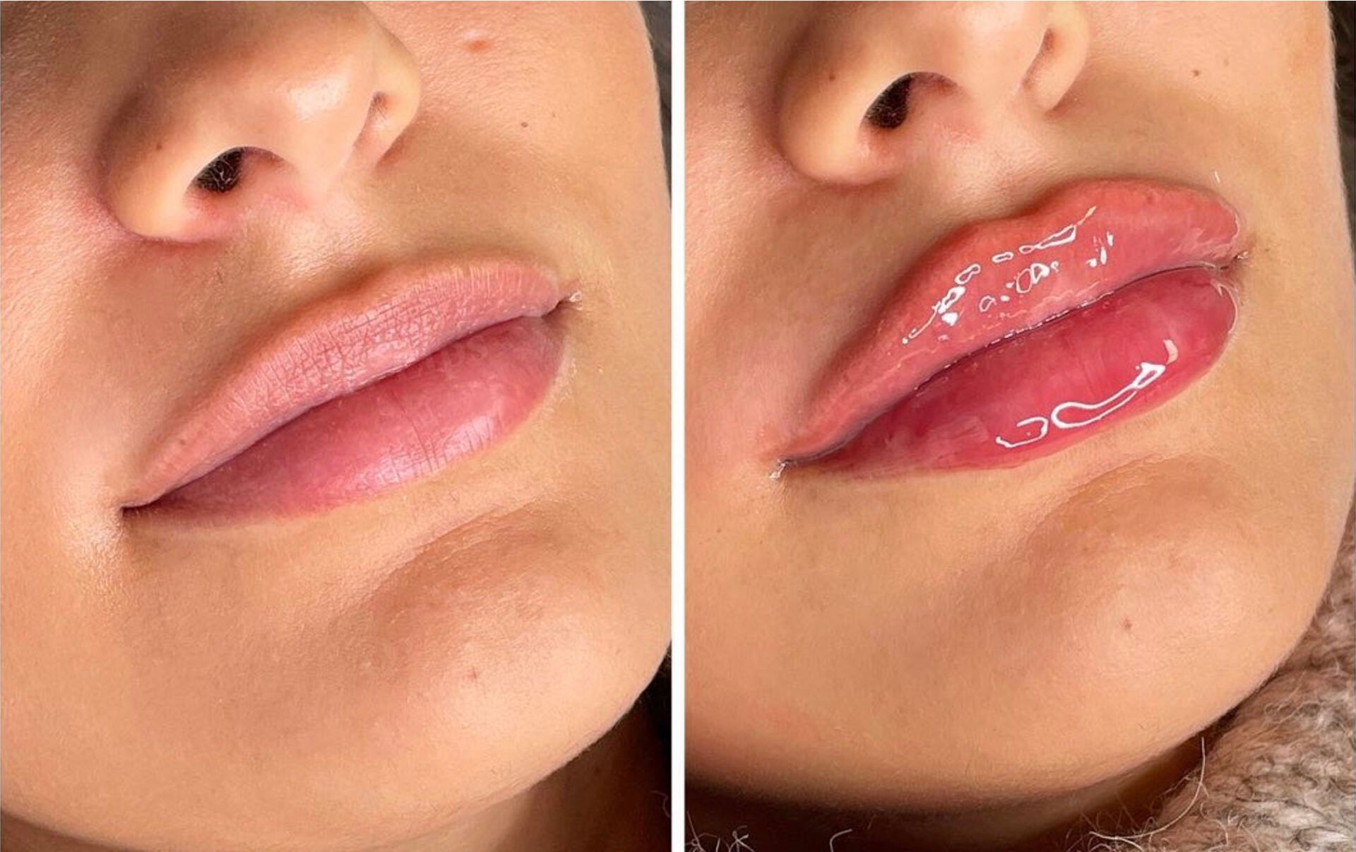 lipfiller den haag lip fillers den haag juvederm